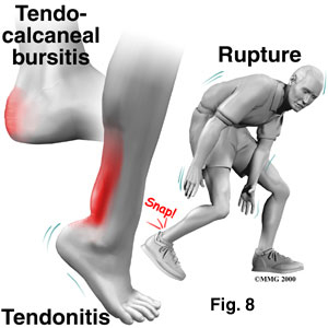 Achilles Tendonitis and Tendon Injuries